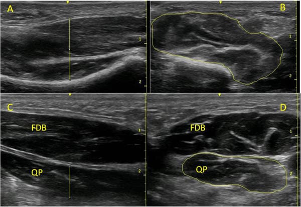 Weight bearing of the foot during ultrasound assessment: the added value
