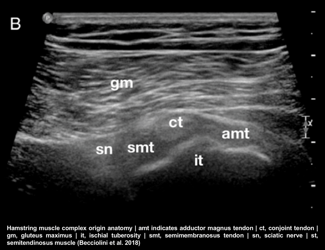 Hamstring injuries as an indication for ultrasound imaging