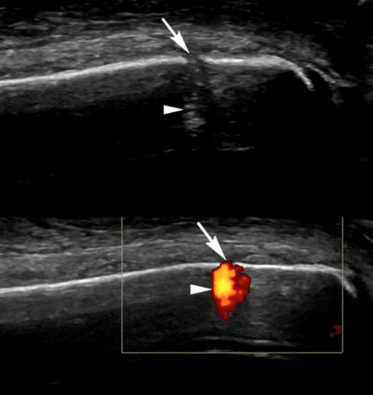 Diagnosing fractures, avulsion fractures and occult fractures with ultrasound