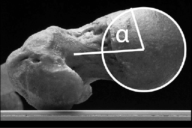Ultrasound evaluation of femoracetabular impingement
