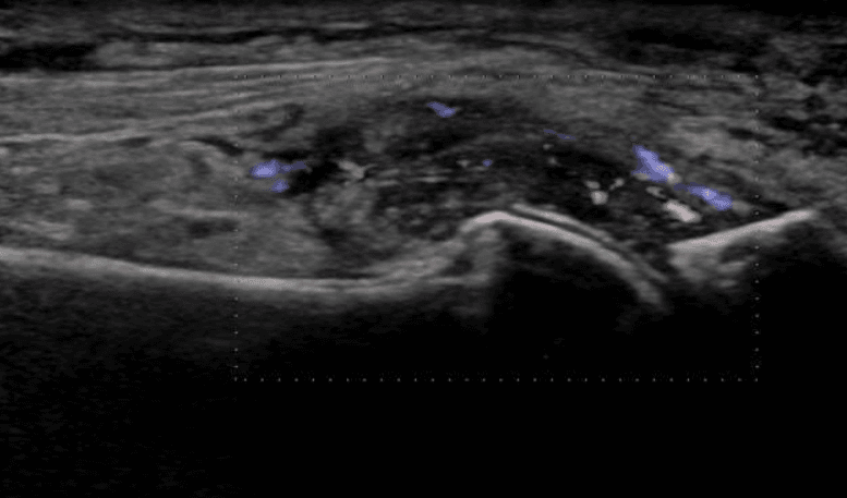 Diagnosis of gout and differentiating gout from other arthritic diseases