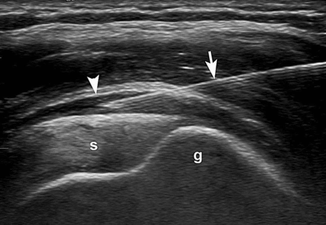 Ultrasound guided injection of the supraspinatus tendon or bursa SASD