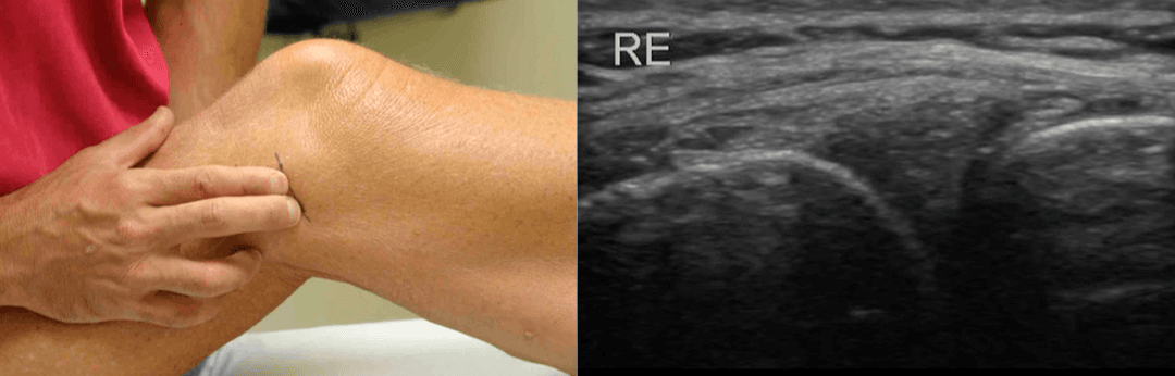 Ultrasound as a tool to improve your palpation skills