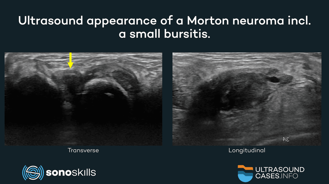 Morton’s neuroma: MRI or musculoskeletal ultrasound?