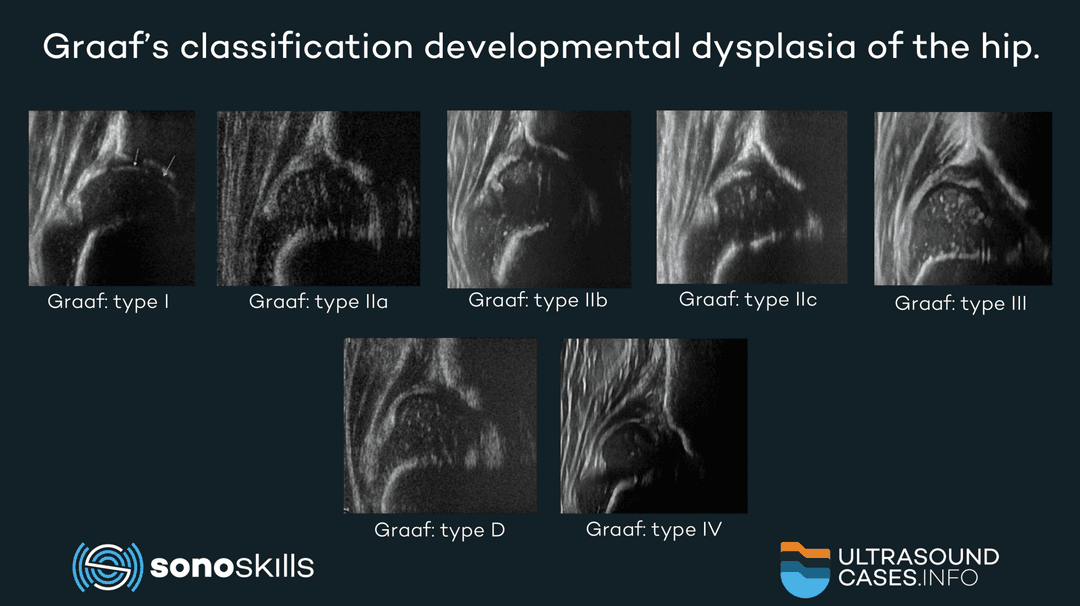 Musculoskeletal ultrasound examination of developmental dysplasia of the hip