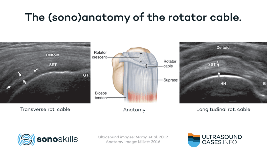 The (sono)anatomy of the rotator cable linked to tendon pathology