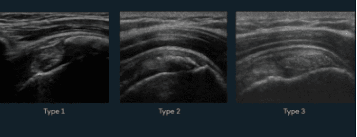Ultrasound-Guided Barbotage of a Calcification: An Approach to Tendon Health
