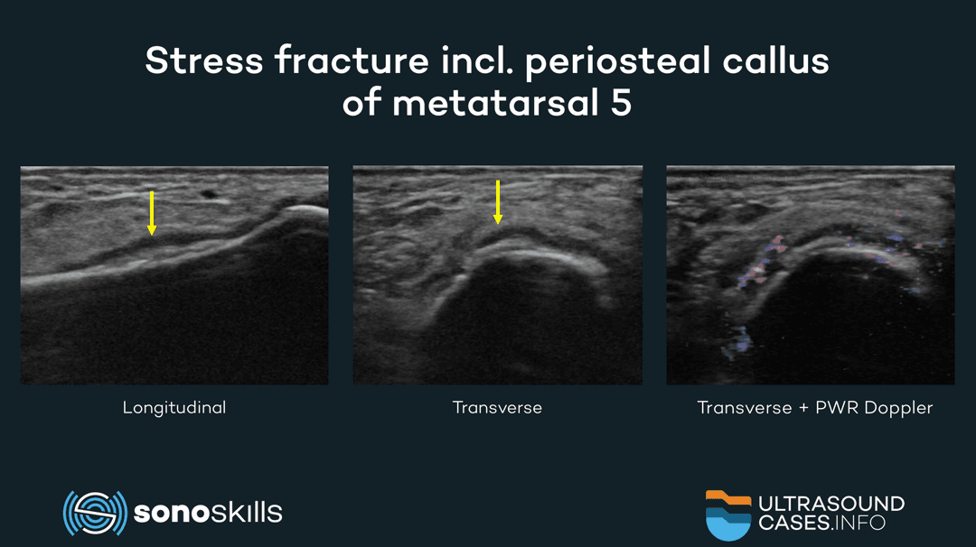 Using musculoskeletal ultrasound in the diagnosis of metatarsal fractures