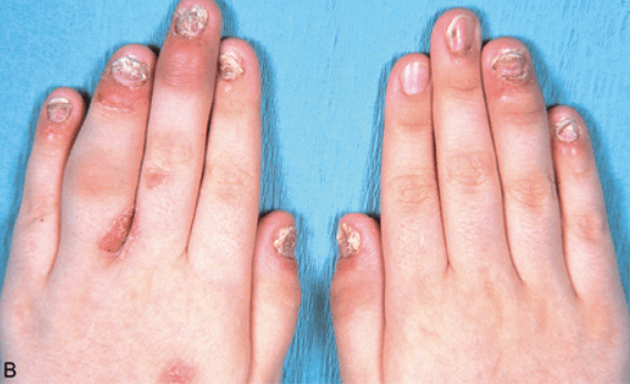 Ultrasound of the small joints of the hand in the polyarticular psoriaticarthritis population