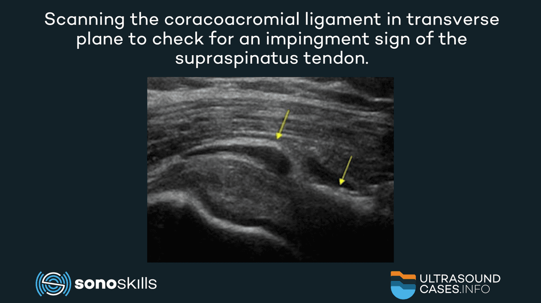Dynamic ultrasound of the supraspinatus to check for impingement with the coracoacromial ligament