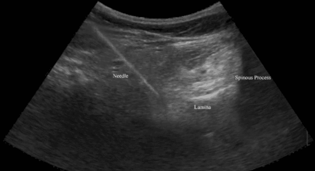 The Advantages of Musculoskeletal Ultrasound Over Fluoroscopy in Performing Spine Interventions