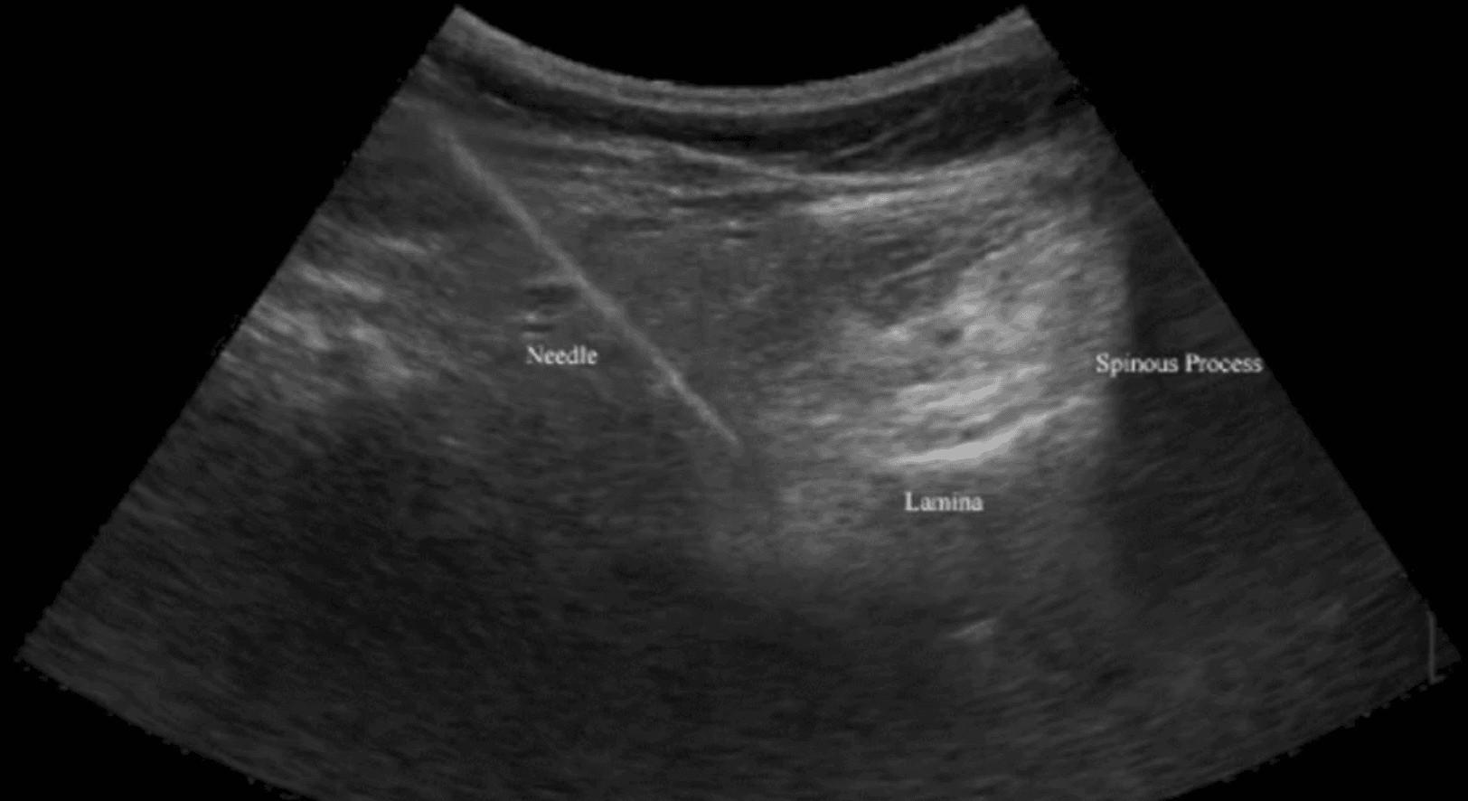 The Advantages of Musculoskeletal Ultrasound Over Fluoroscopy in Performing Spine Interventions