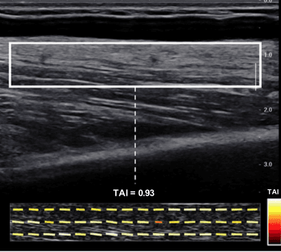 The texture anisotropy index to differentiate healthy and disordered muscles with ultrasound
