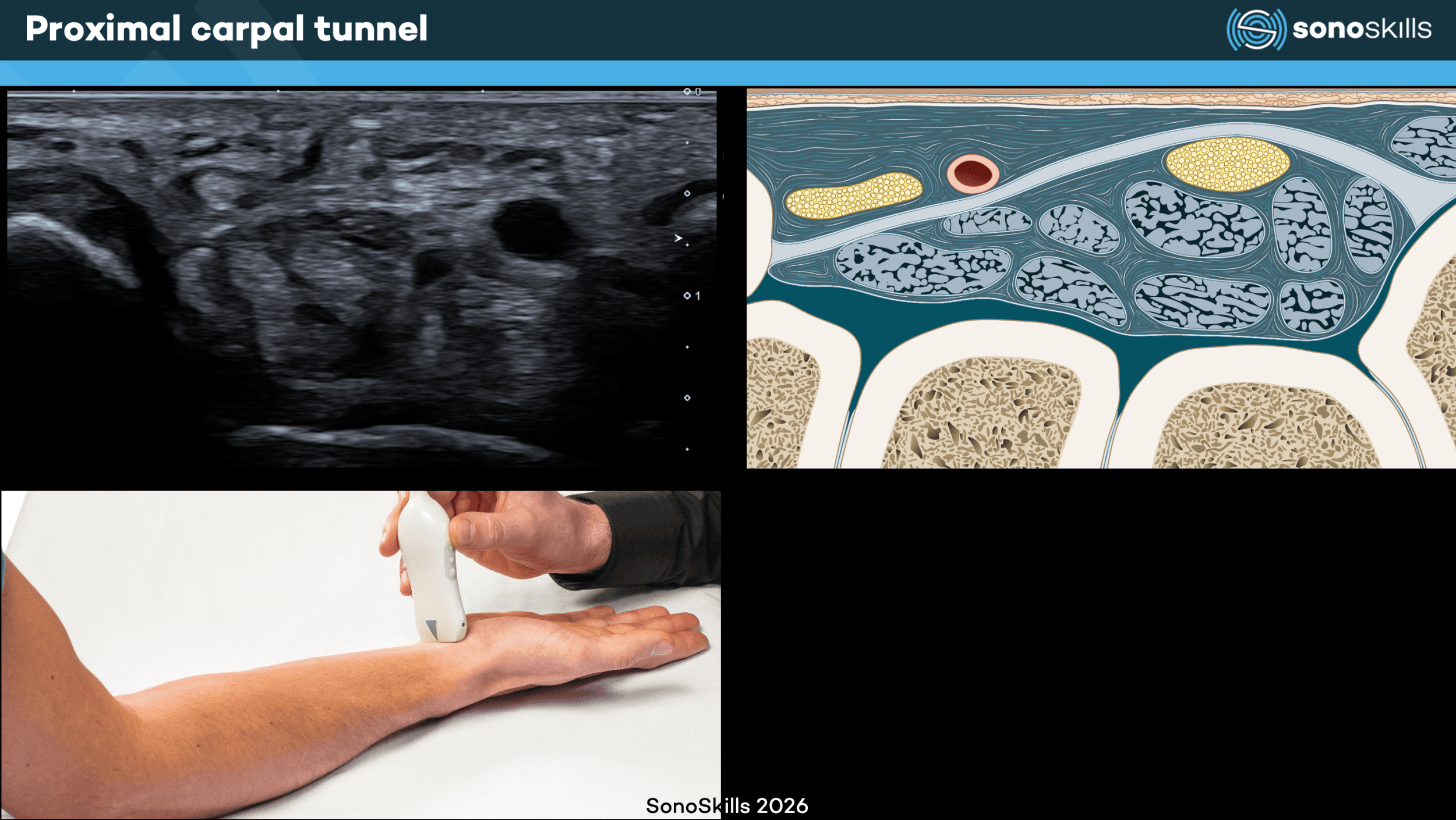 Minimally Invasive Ultrasound-Guided Carpal Tunnel Release