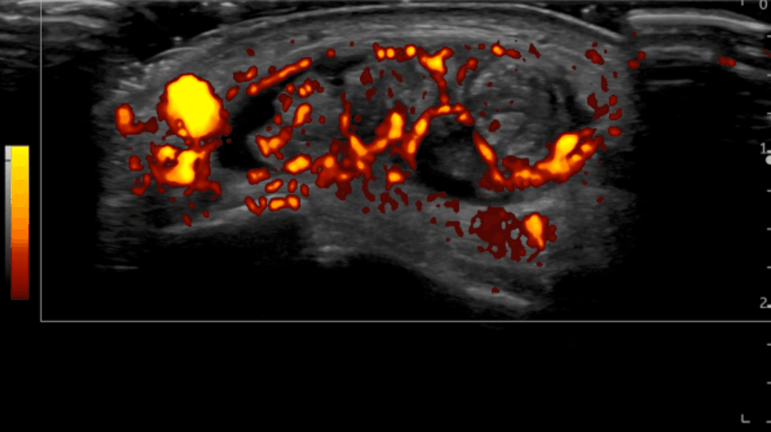 Ultrasound Imaging of Neovascularization in Musculoskeletal Pathologies: Why and How Should We Do It?