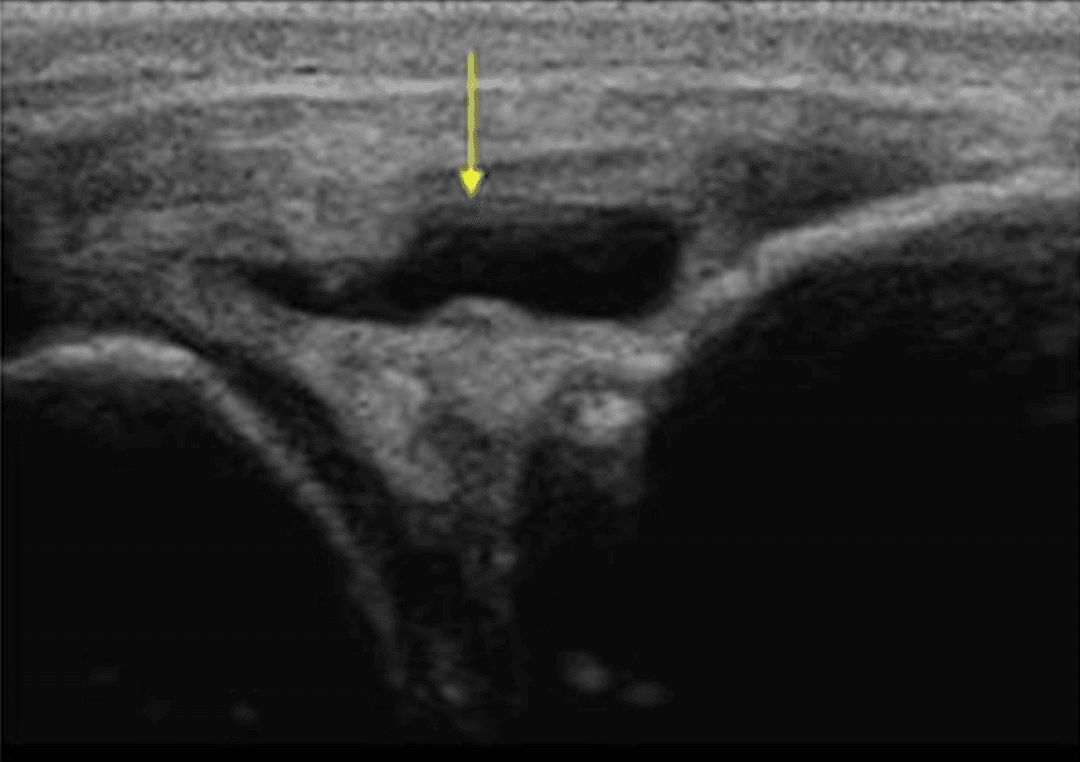 The reliability of medial knee gap measurement with musculoskeletal ultrasound