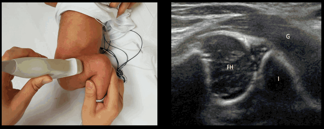 Detecting acetabular dysplasia or hip dislocation in early infancy