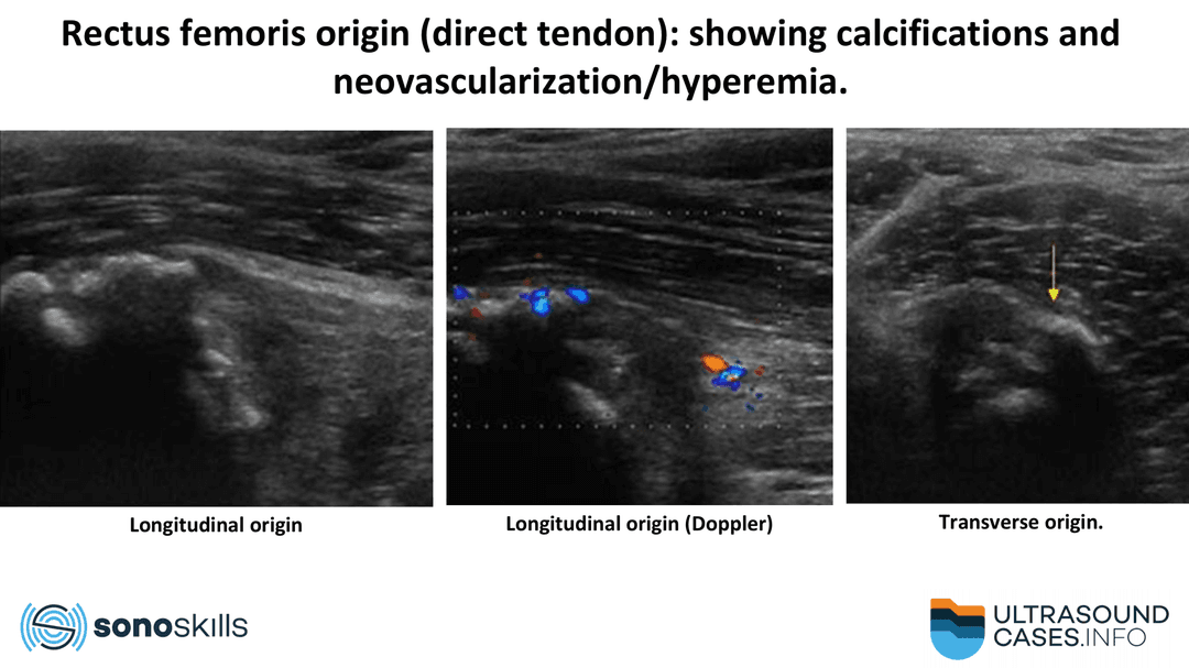 Calcific tendinopathy of the rectus femoris tendon: the ultrasound appearance