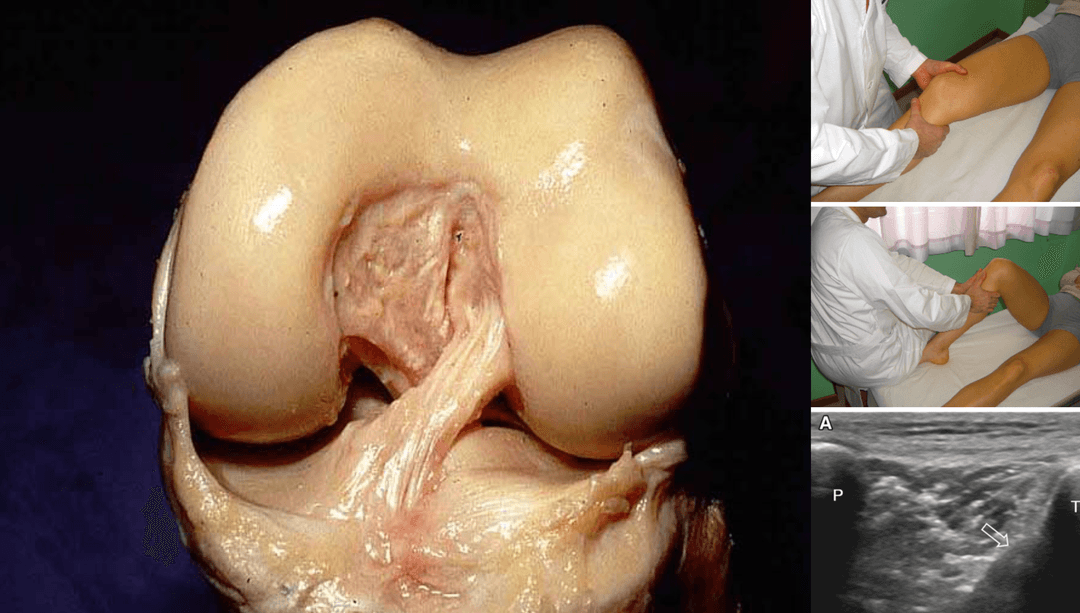 Diagnostic accuracy of dynamic ultrasound imaging in cruciate ligament tears