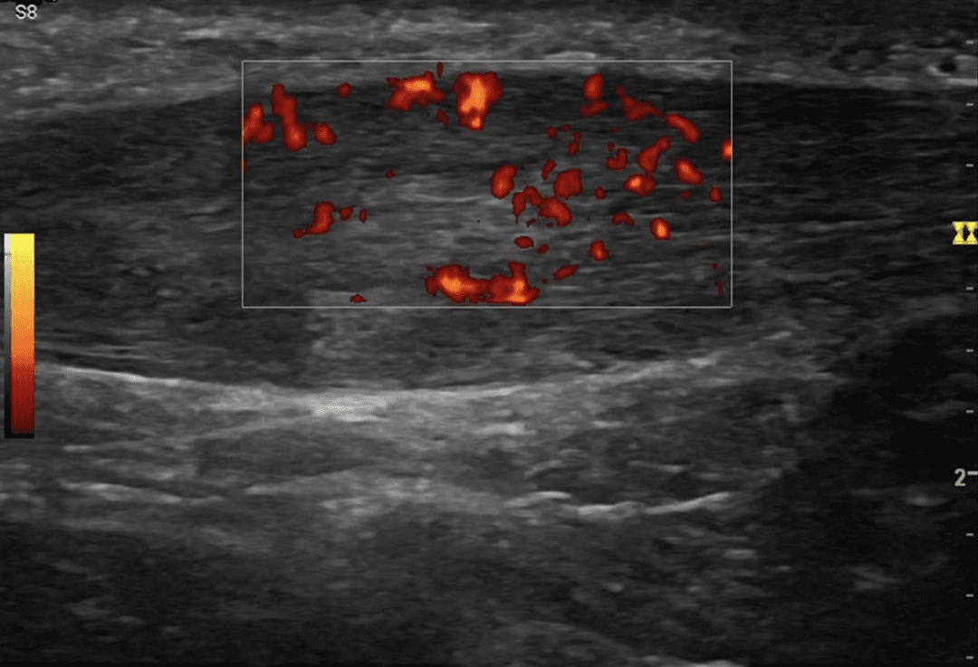 A standardizing method to assess tendon structural change on ultrasound
