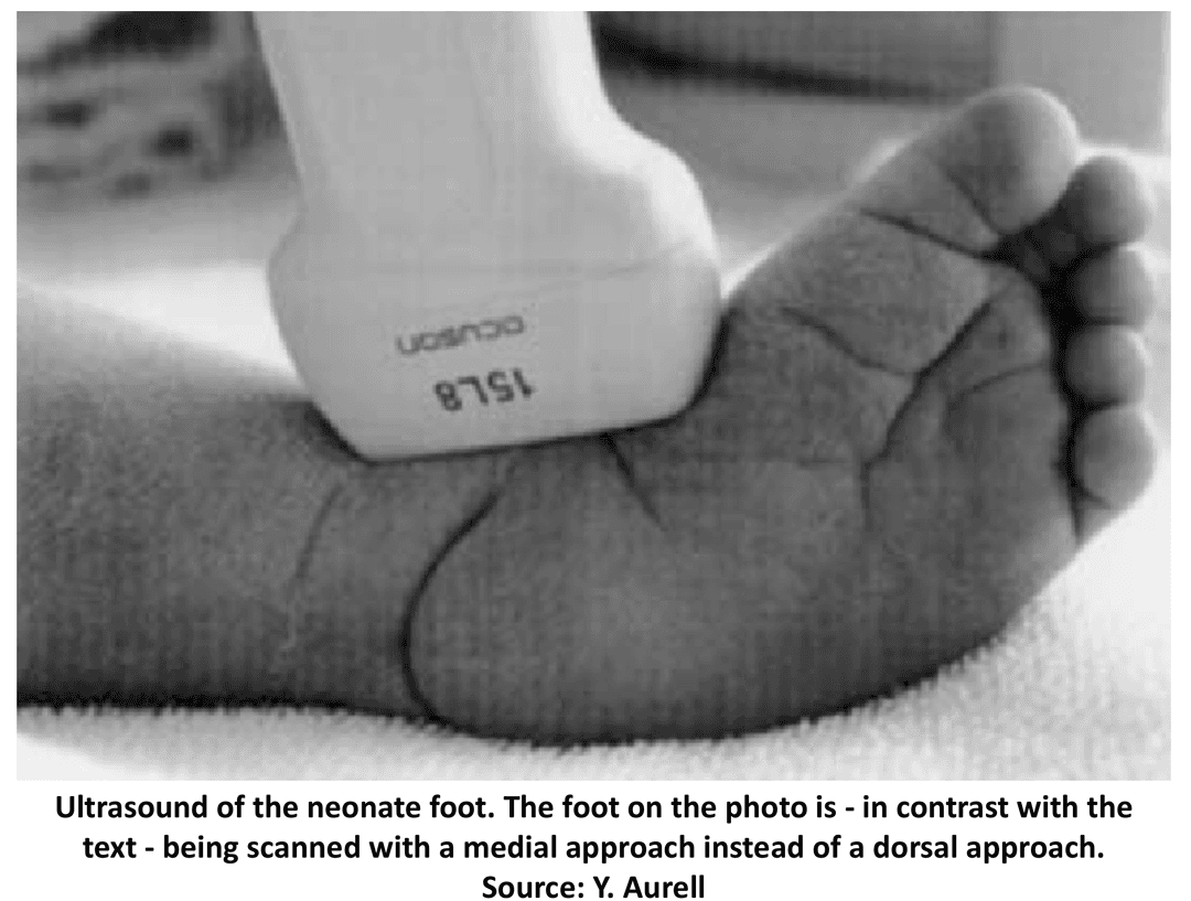Dynamic real time ultrasound of the clubfoot and ankle joint