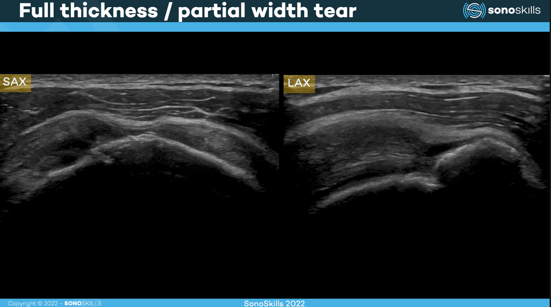 Knowledge on Rotator Cuff Tears You Should Know Before Starting a Musculoskeletal Ultrasound Exam