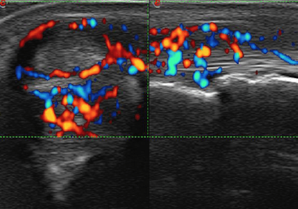 Tenosynovitis scoring system for greyscale and Doppler ultrasound