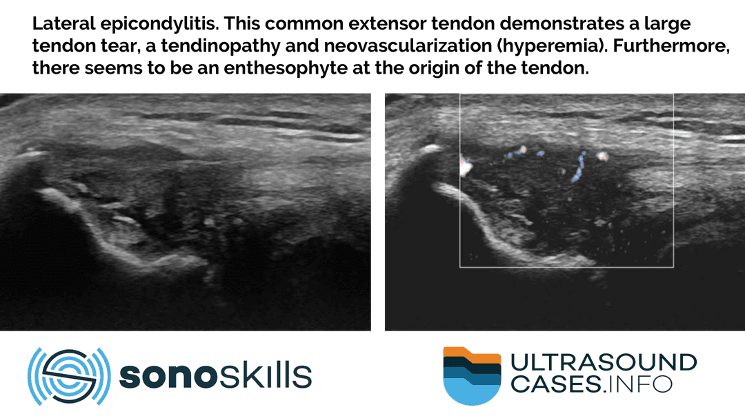 Lateral epicondylitis clinically presents as focal tenderness at the lateral epicondyle