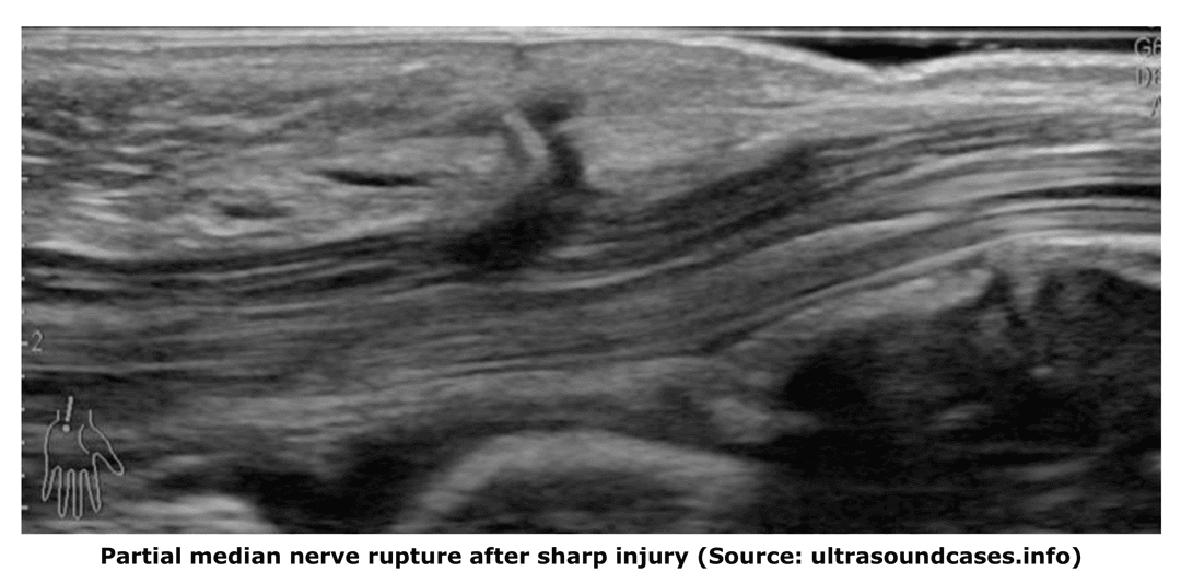Ultrasound of peripheral nerves: an article suggestion
