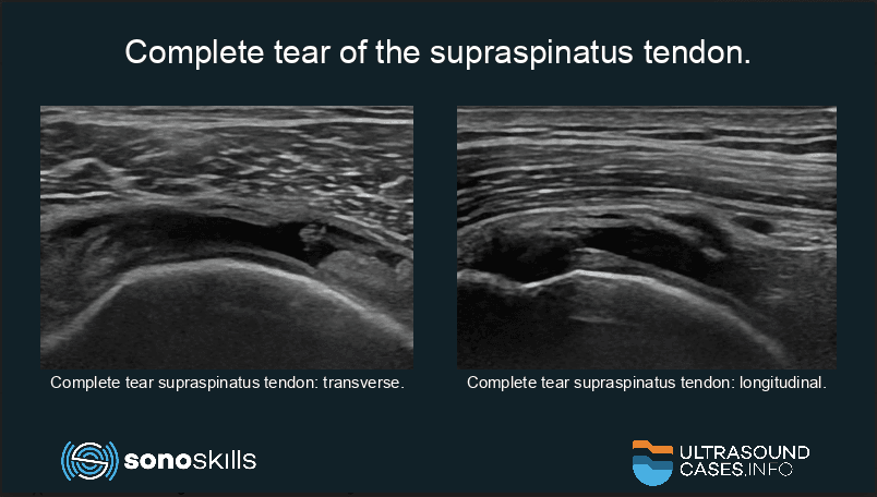 The risk of retearing the rotator cuff after surgical repair