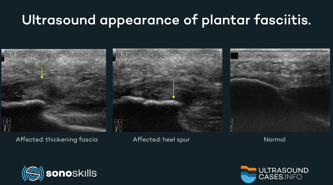 Comparing ultrasound with MRI and CT in measuring the plantar fascia