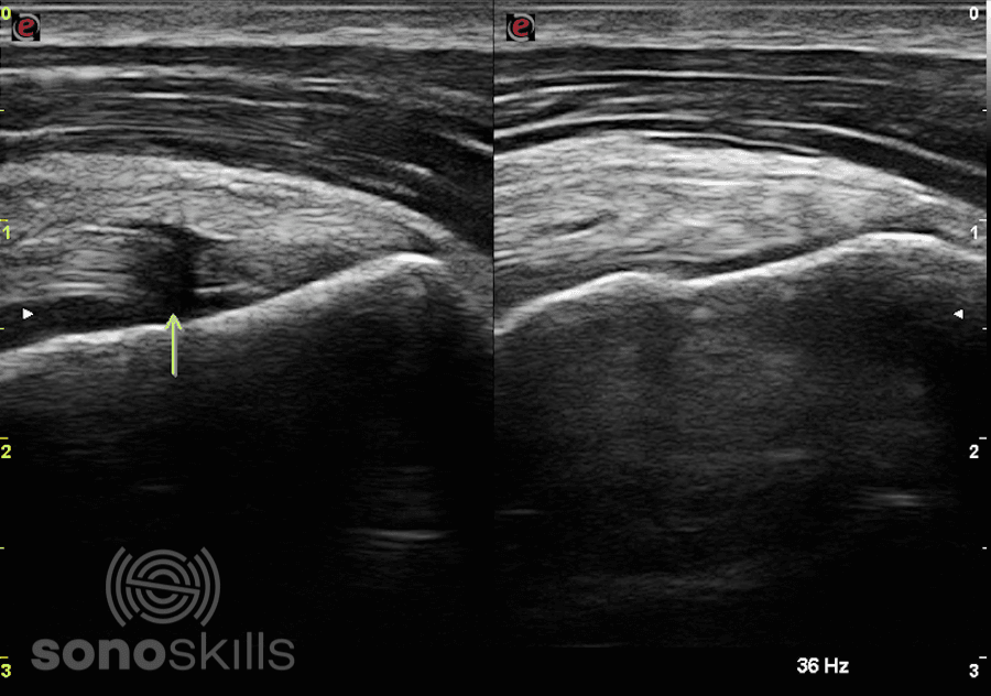 Shoulder injuries in waterpolo players