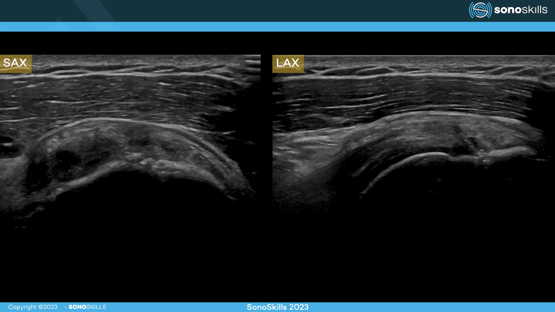Exploring Soft Tissue Evaluation with Musculoskeletal Ultrasound