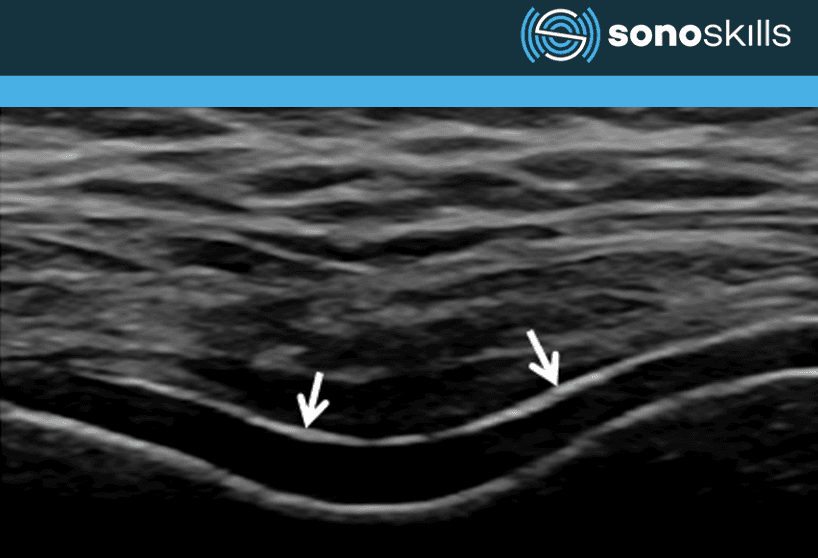 Revolutionizing Rheumatology with Musculoskeletal Ultrasound