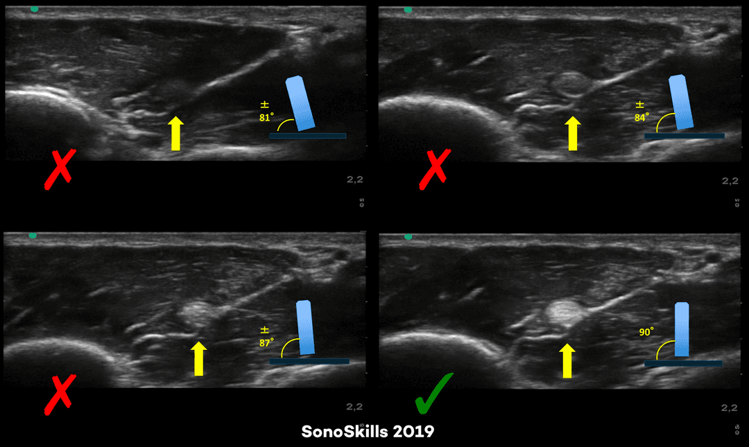Anisotropy as most important pitfall in ultrasound imaging