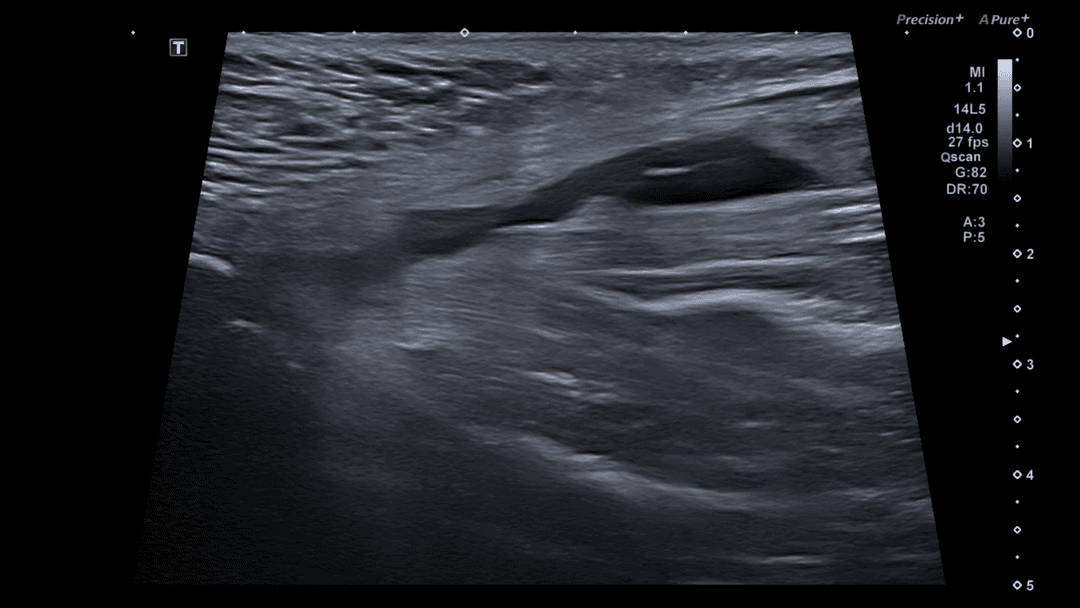 Adductor Longus Muscle Tear