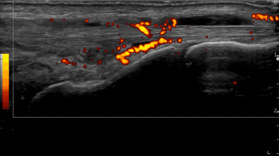 Understanding Neovascularization in Musculoskeletal Pathologies: Anatomical and Pathological Insights