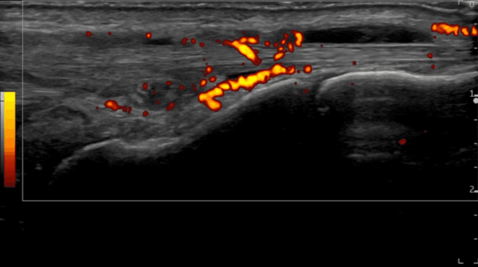 Understanding Neovascularization in Musculoskeletal Pathologies: Anatomical and Pathological Insights