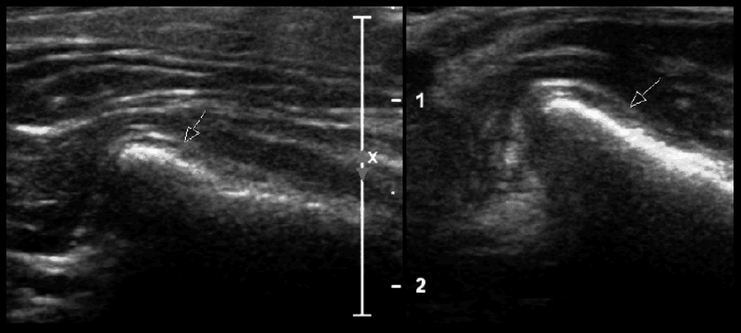 The value of ultrasound for ruling in or out disc displacement in the temporomandibular joint