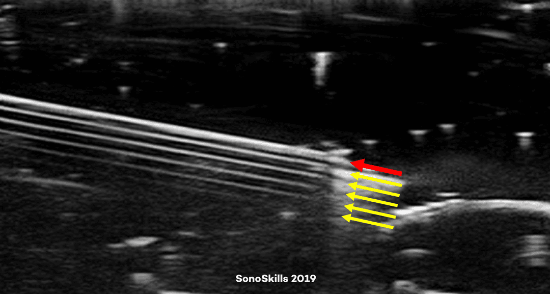 Reverberation artifact in ultrasound imaging
