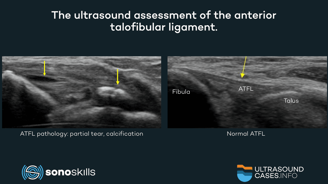 Sports injury of the anterior talofibular ligament: how to enhance the reliability of the musculoskeletal ultrasound