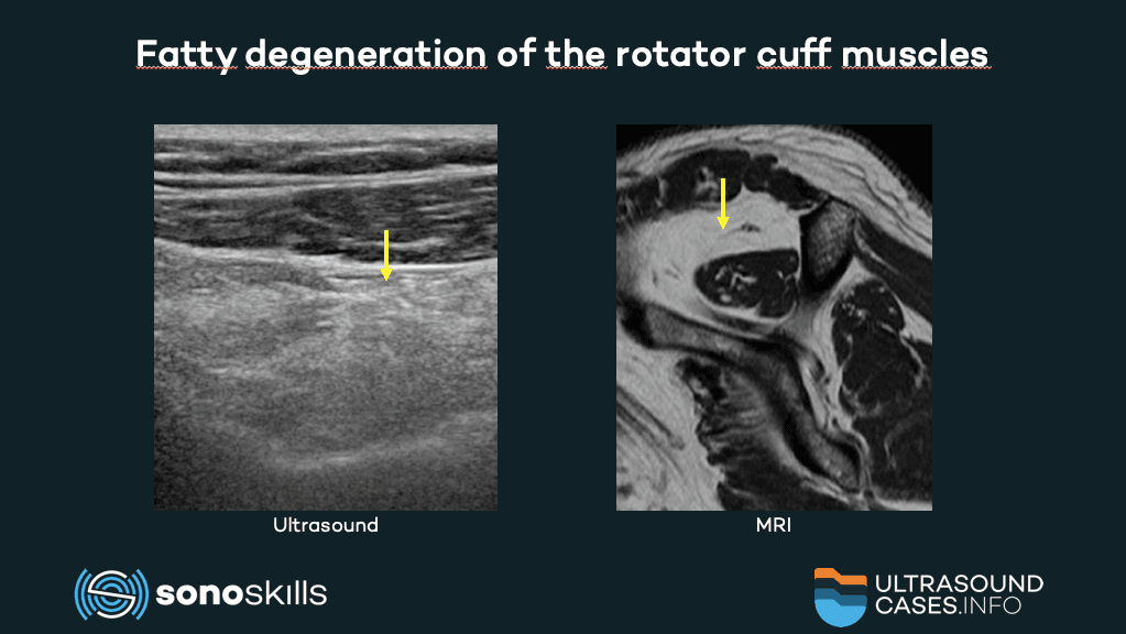 Musculoskeletal ultrasound versus MRI in the detection of fatty degeneration of the rotator cuff muscles