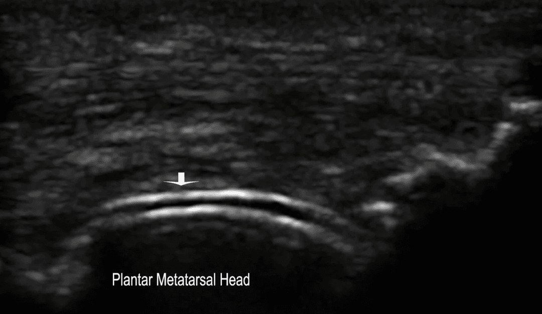 Musculoskeletal Ultrasound in the Diagnosis of Gout and Crystal Deposition Diseases