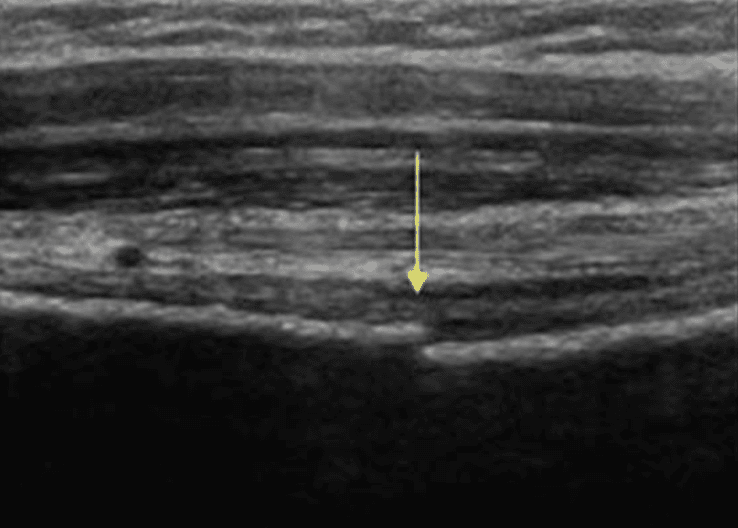 The added value of using ultrasound assessment in the Ottawa Foot and Ankle rules