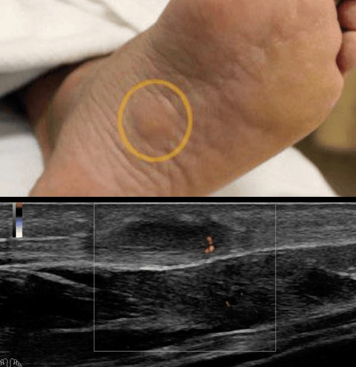 The role of ultrasound in diagnosing tumors