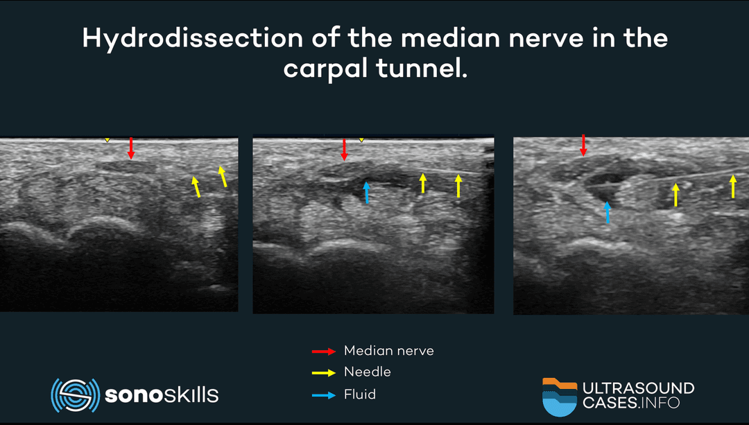 Using ultrasound, fluid and a needle to dissect the median nerve