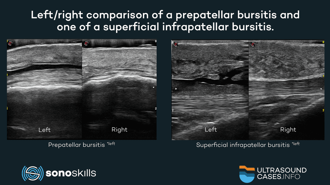 The advantages of musculoskeletal ultrasound: zooming in on making left/right comparisons