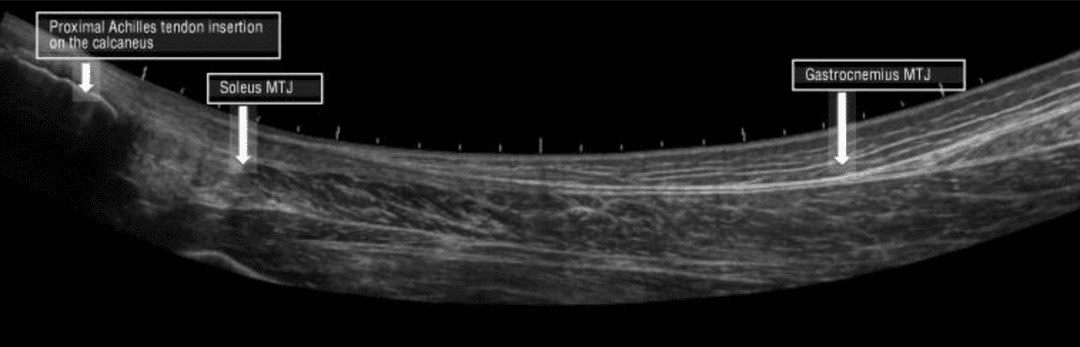 The reliability of ultrasound assessment of the Achilles tendon