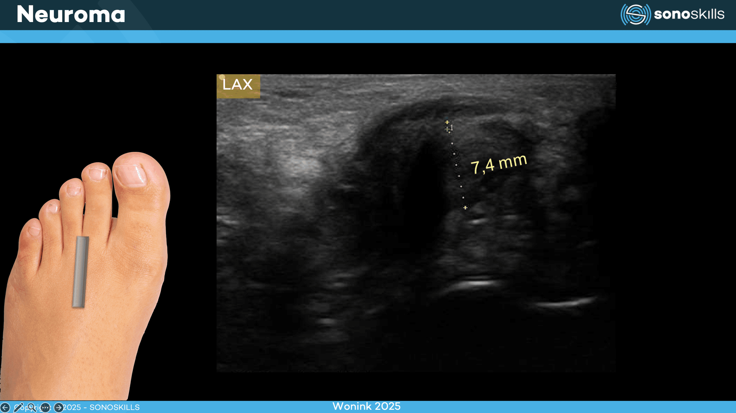 Top 10 Pathologies You Can Detect with MSK Ultrasound