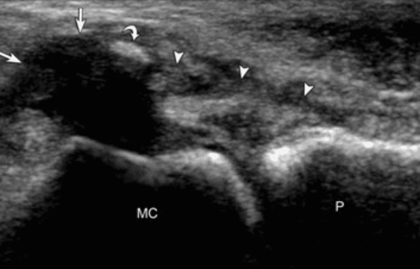 The Role of Musculoskeletal Ultrasound in Preoperative Planning